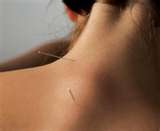 neck acupuncture